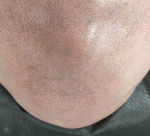 Mikropigmentacja skóry głowy - efekt krótko ściętych włosów 
