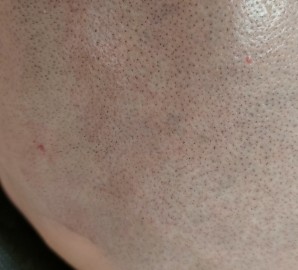Mikropigmentacja skóry głowy - efekt krótko ściętych włosów 