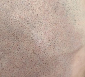 Mikropigmentacja skóry głowy - efekt krótko ściętych włosów 